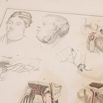 BOK, "Akiurgische abbildungen...der blutigen..operationen..", Dr. Ernst Blasius, Berlin 1833.