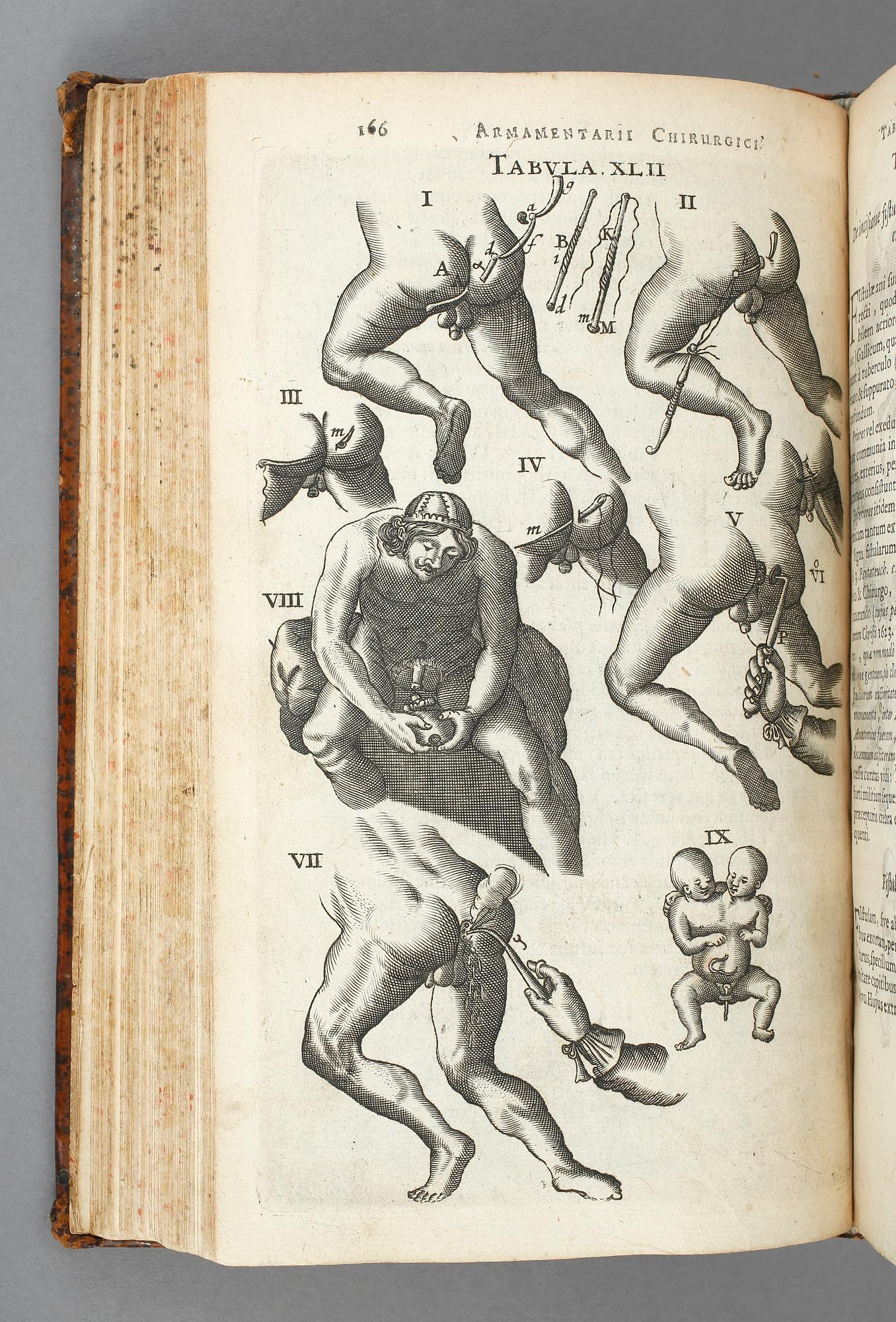 JOHAN SCULTETI, Armamentarium Chirurgicum, Haag 1657.