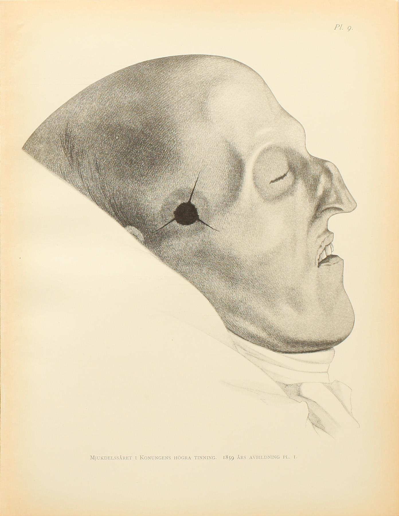 RÖNTGENBILD av Karl XII, silvergelatinfotografi.